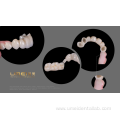 Zirconia bridge